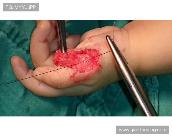 麦凯恩成功接受拇指韧带修复手术预计缺阵至少一个月